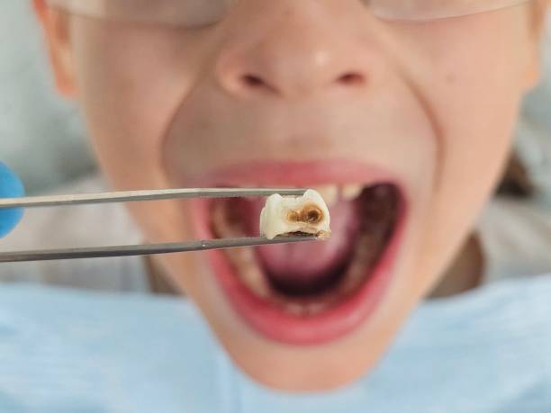 Best Emergency Broken Tooth Repair in Winner, SD